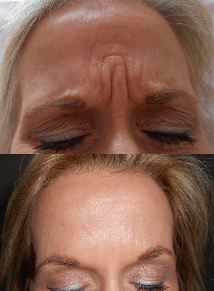 Botox Bromley