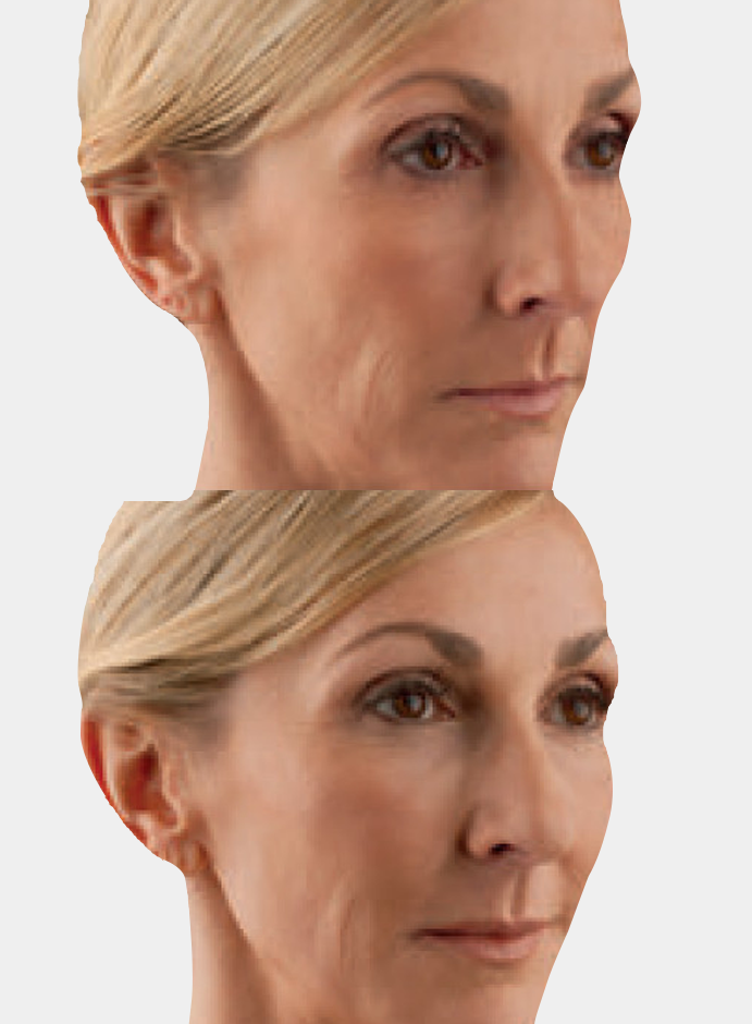 Cheek Augmentation