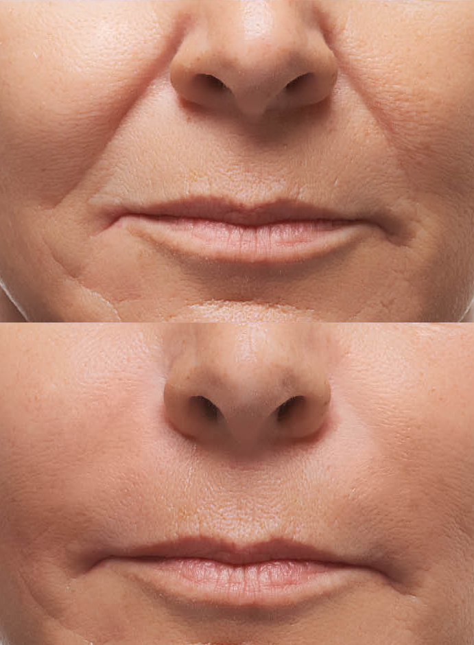 Dermal Fillers Bromley