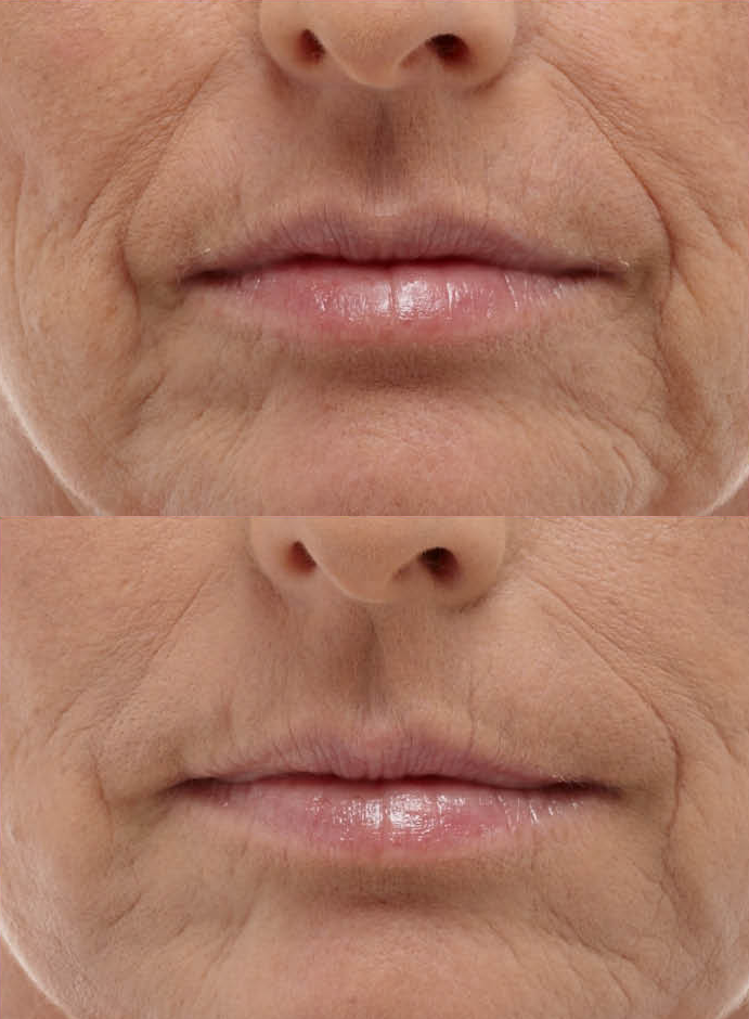 Facial Fillers Bromley