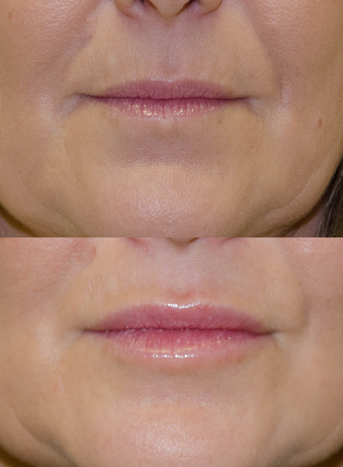 Lip Enhancement Bromley