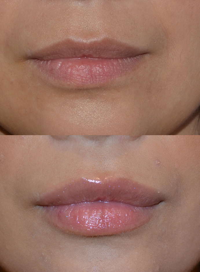 Lip Enhancement