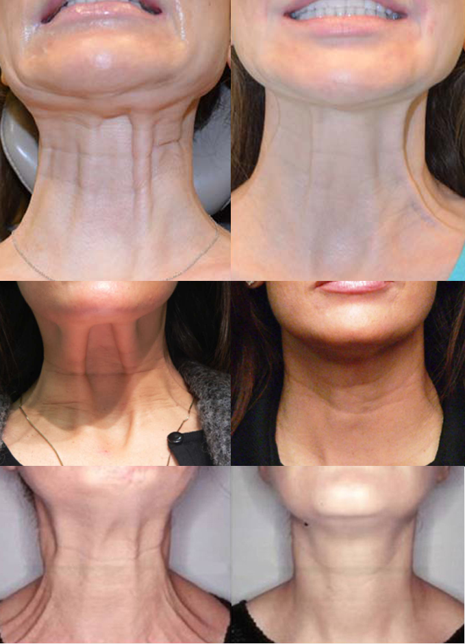 Neck Ageing Treatment Bromley