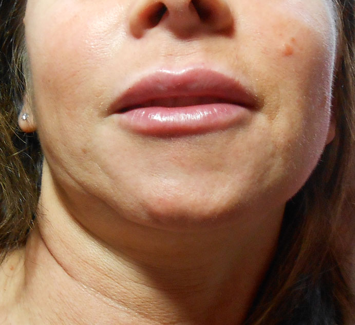 After lip filler using Juvederm