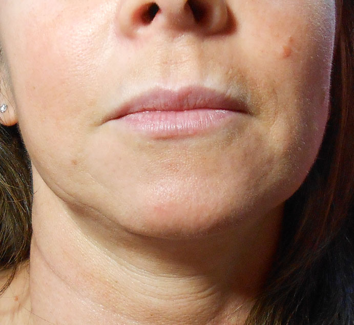 Before Lip Filler Using Juvederm